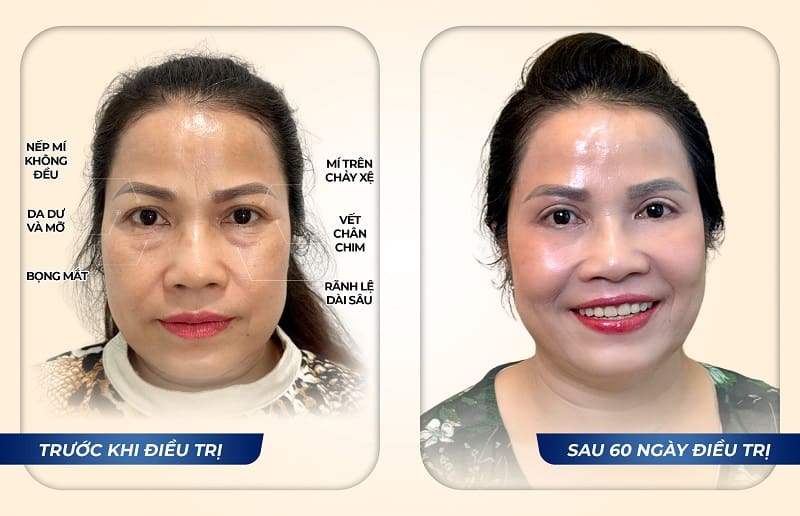 Kết quả điều trị bọng mắt tại Dr. Eye – Chị Hồng Phượng, sau 60 ngày