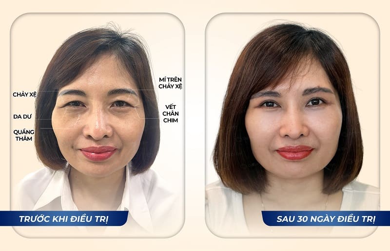 Kết quả điều trị bọng mắt tại Dr. Eye – Chị Lê Thị Hoa, sau 30 ngày