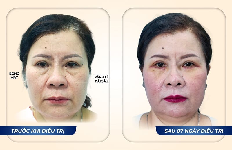 Kết quả điều trị bọng mắt tại Dr. Eye – Chị Lê Thị Minh, sau 7 ngày